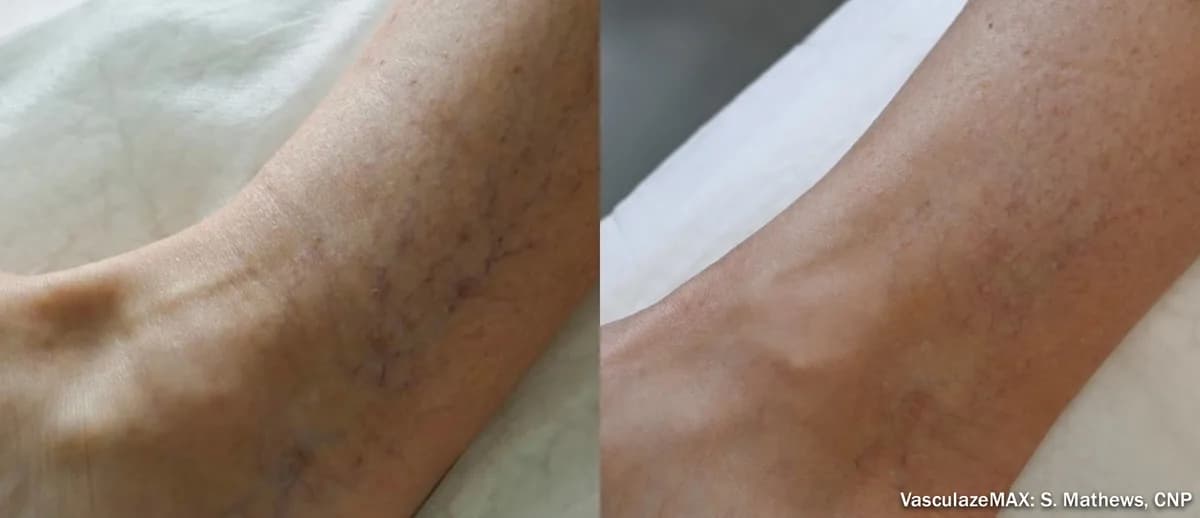 InMode Vasculaze® Max laser Nd:YAG long pulse : résultat avant et après, cas 8