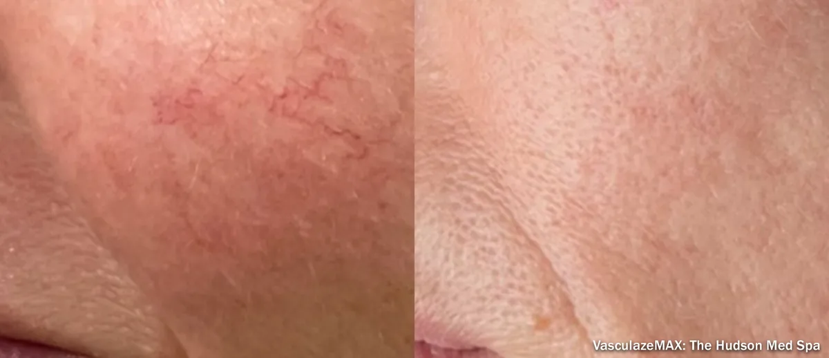 InMode Vasculaze® Max laser Nd:YAG long pulse : résultat avant et après, cas 9