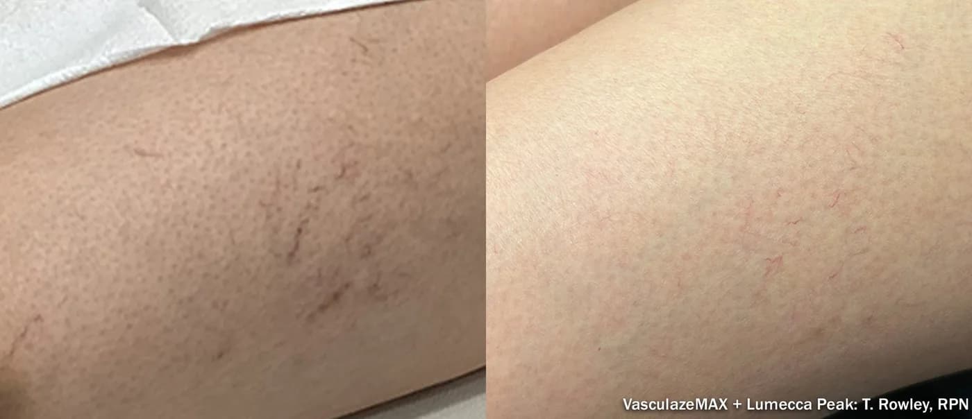 InMode Vasculaze® Max laser Nd:YAG long pulse : résultat avant et après, cas 1