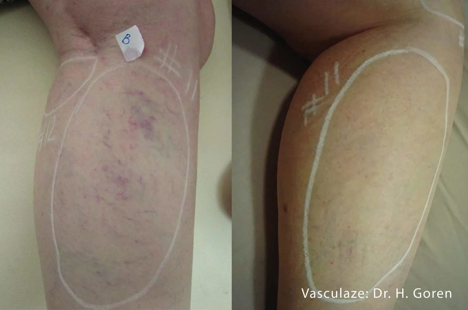 InMode Vasculaze® Max laser Nd:YAG long pulse : résultat avant et après, cas 10