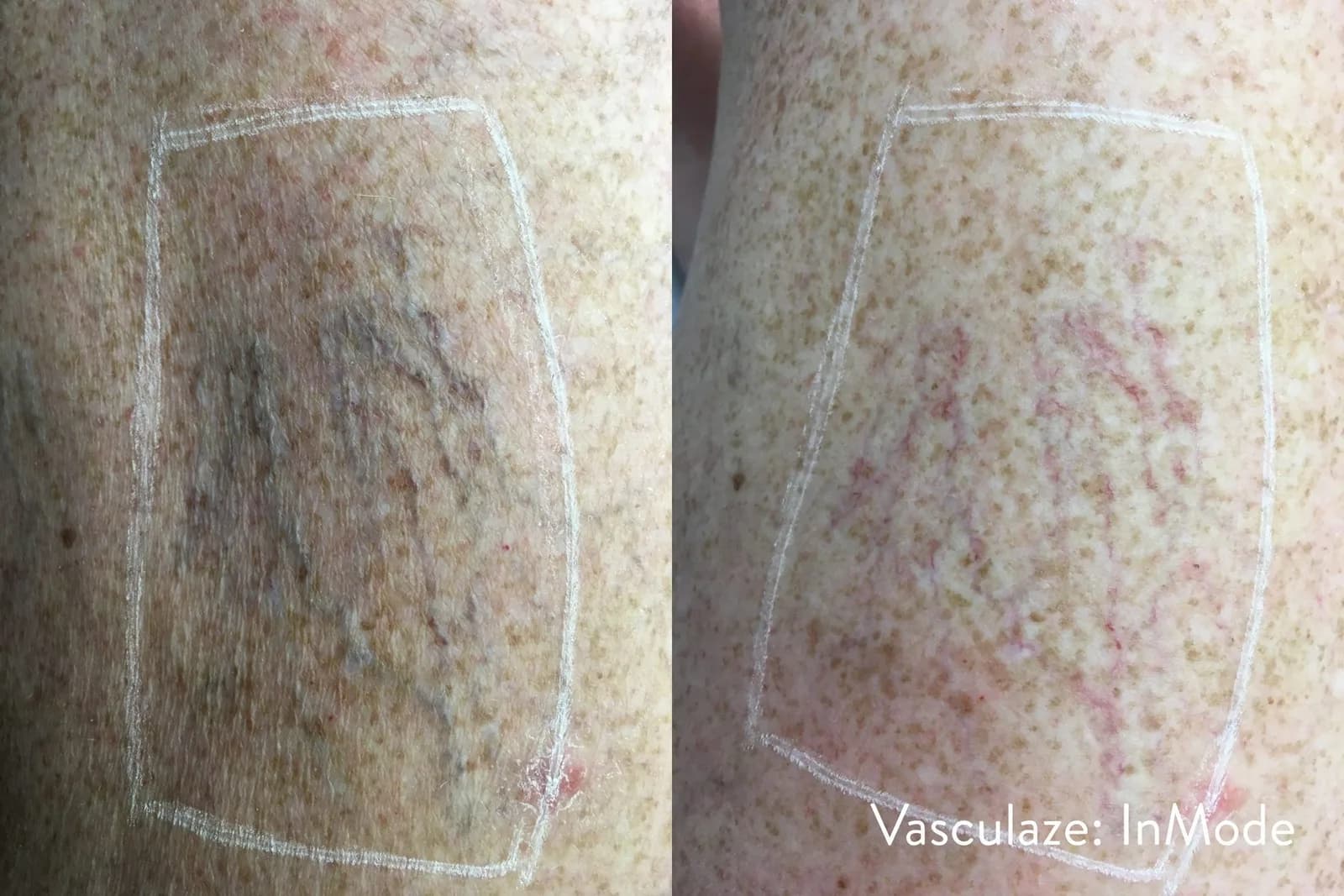 InMode Vasculaze® Max laser Nd:YAG long pulse : résultat avant et après, cas 11