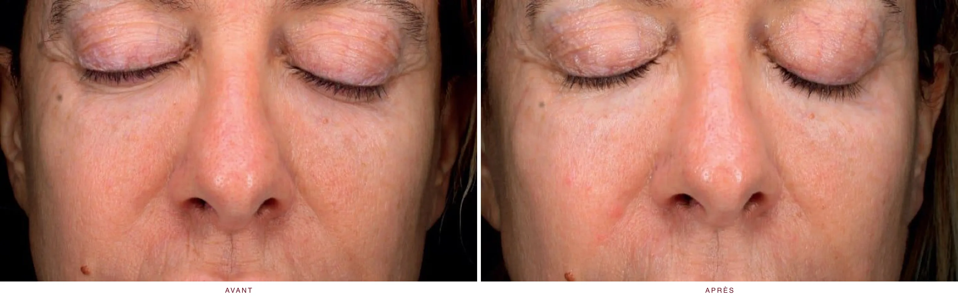Peeling : résultat avant et après, cas 1