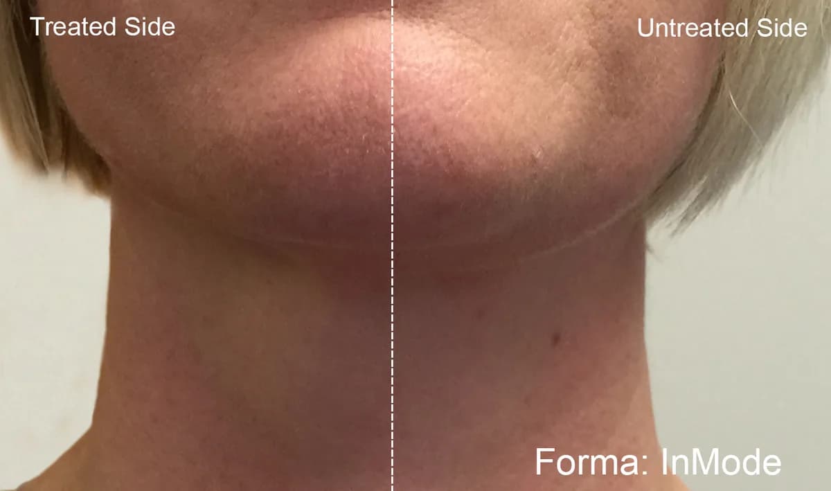 Forma : résultat avant et après, cas 2