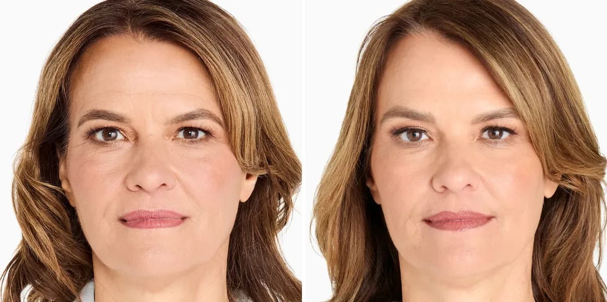 Merz Ultherapy PRIME® : résultat avant et après, cas 11