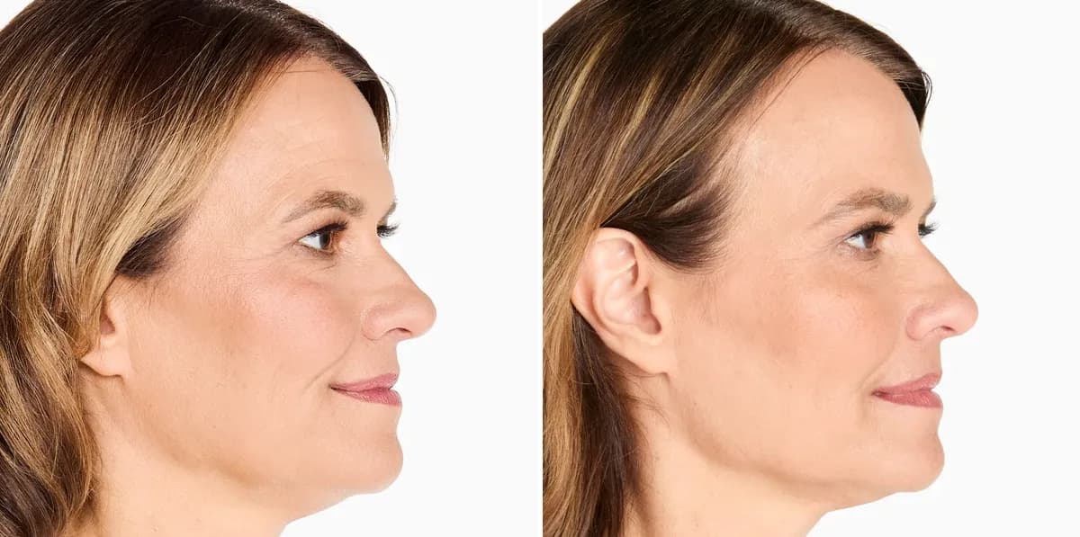 Merz Ultherapy PRIME® : résultat avant et après, cas 12