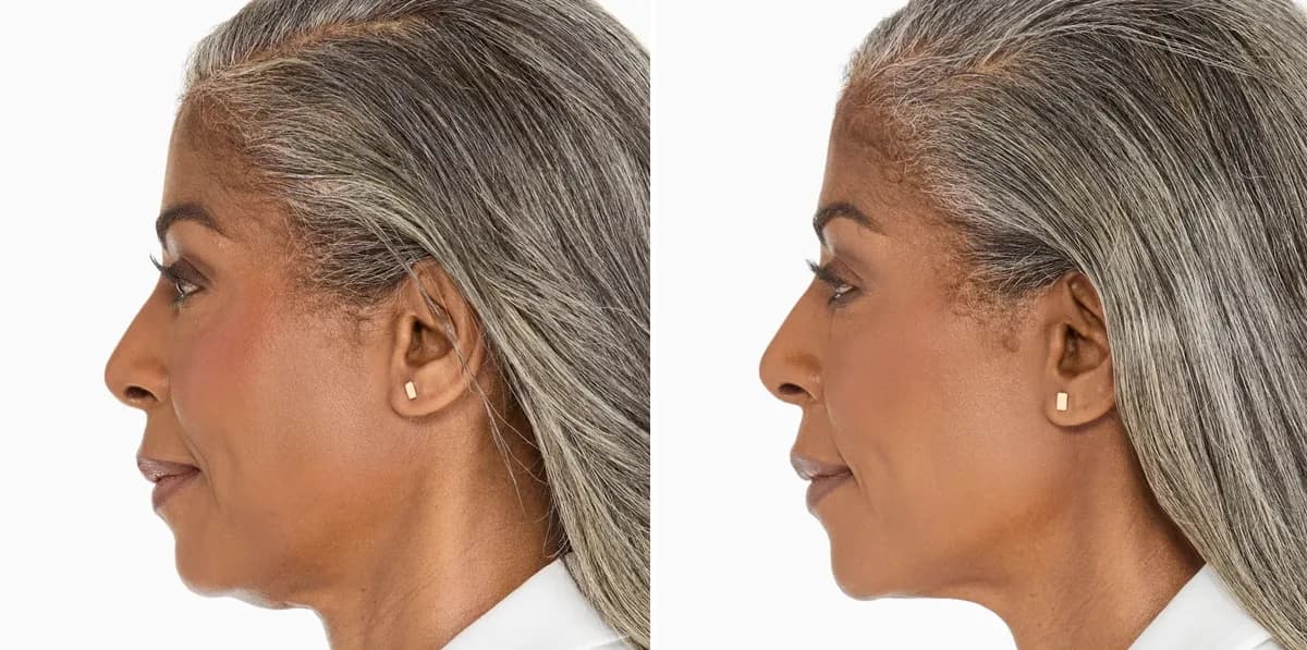 Merz Ultherapy PRIME® : résultat avant et après, cas 13