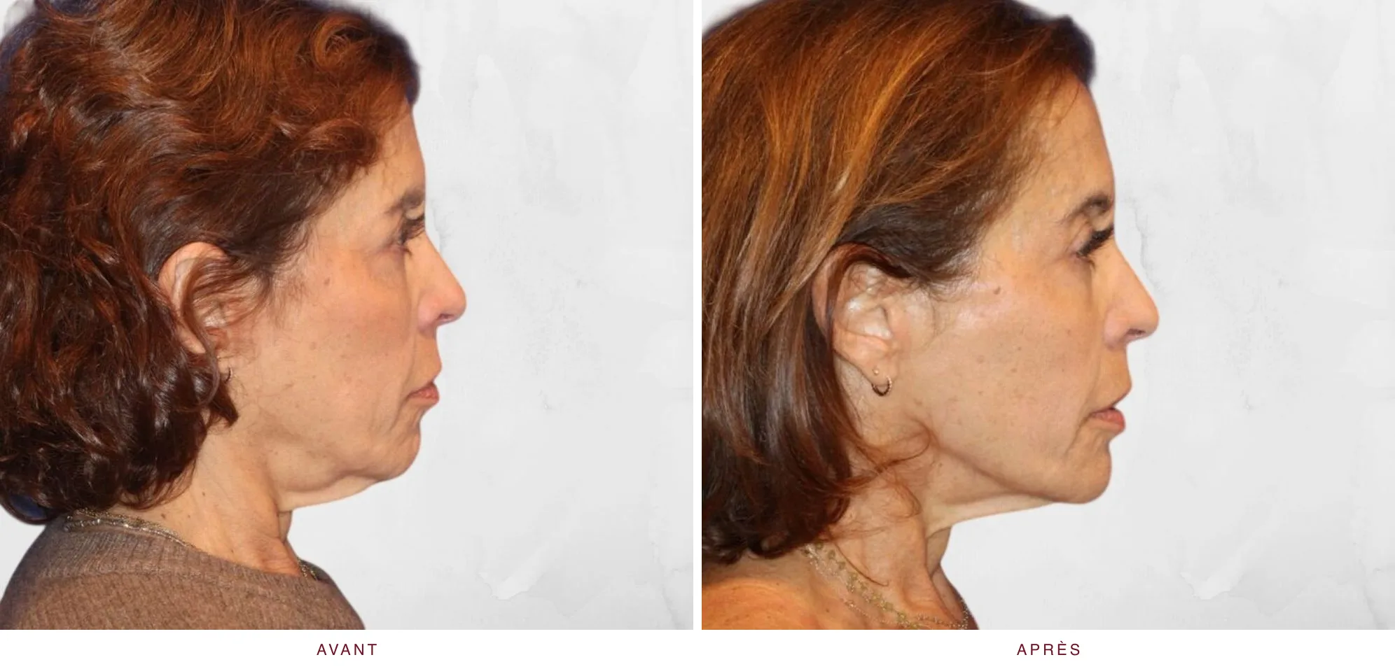 Merz Ultherapy PRIME® : résultat avant et après, cas 14