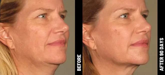 Merz Ultherapy PRIME® : résultat avant et après, cas 3