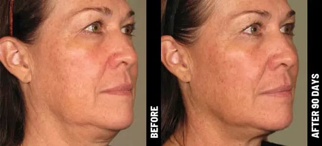Merz Ultherapy PRIME® : résultat avant et après, cas 4