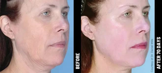 Merz Ultherapy PRIME® : résultat avant et après, cas 3