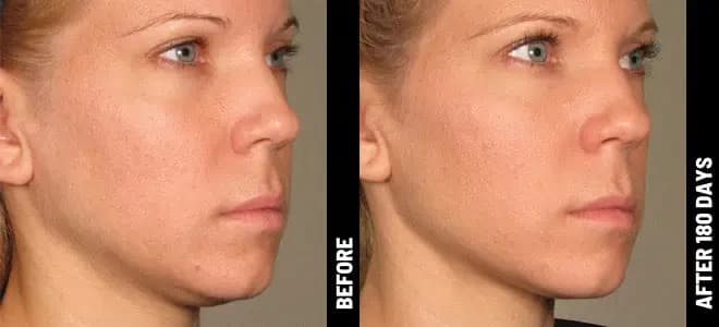 Merz Ultherapy PRIME® : résultat avant et après, cas 4
