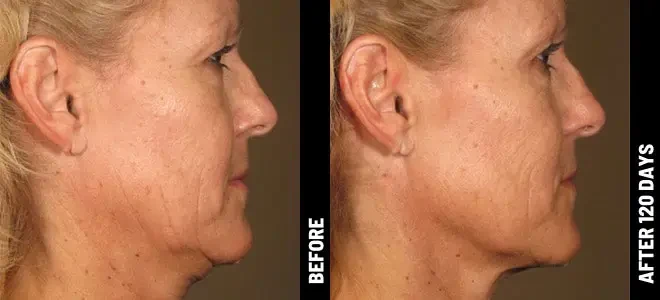 Merz Ultherapy PRIME® : résultat avant et après, cas 5