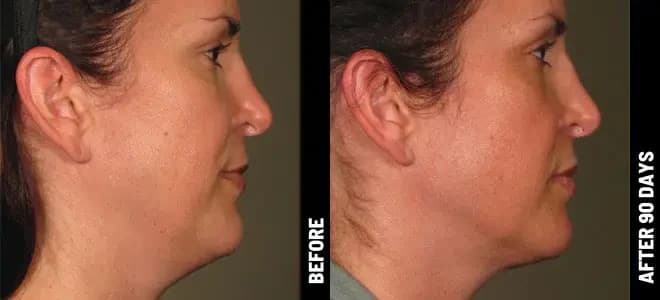 Merz Ultherapy PRIME® : résultat avant et après, cas 6