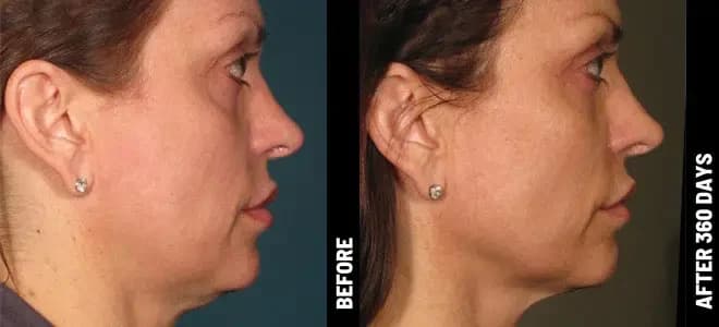 Merz Ultherapy PRIME® : résultat avant et après, cas 7
