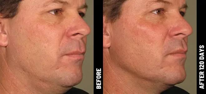 Merz Ultherapy PRIME® : résultat avant et après, cas 8