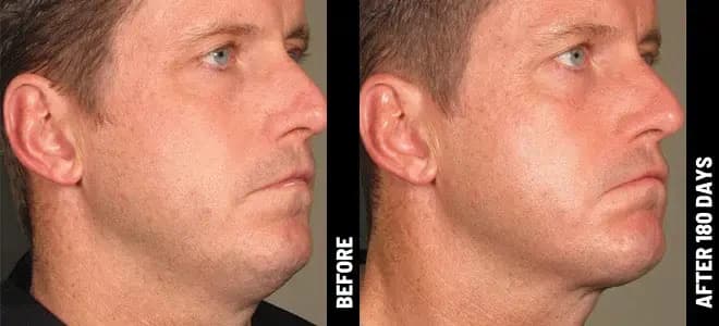 Merz Ultherapy PRIME® : résultat avant et après, cas 9