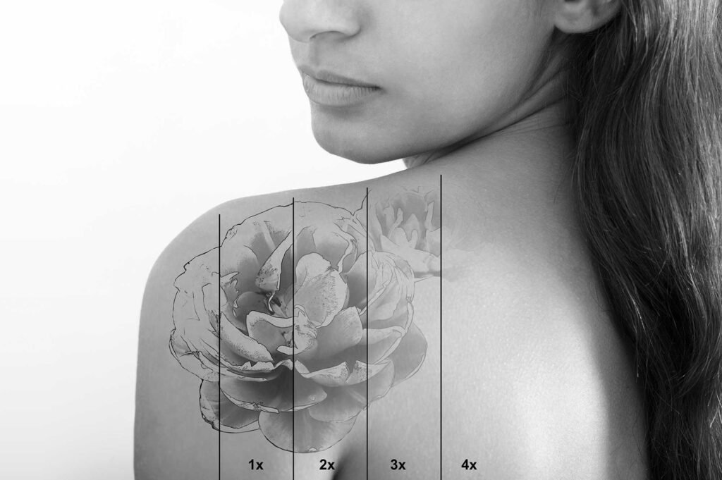 Détatouage laser à Clermont-Ferrand