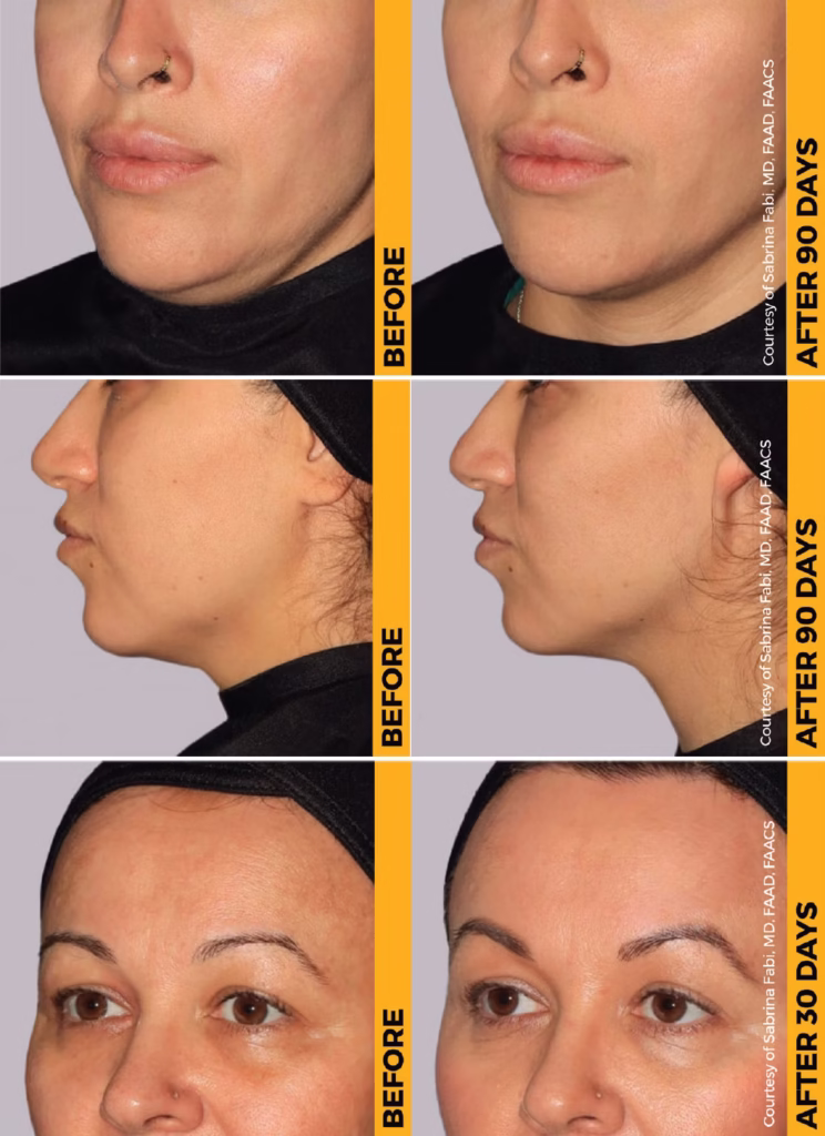 Ultherapy-prime-resultats
