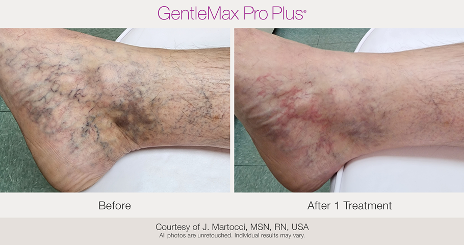 candela gentle max pro plus gllx vasculaire jambe