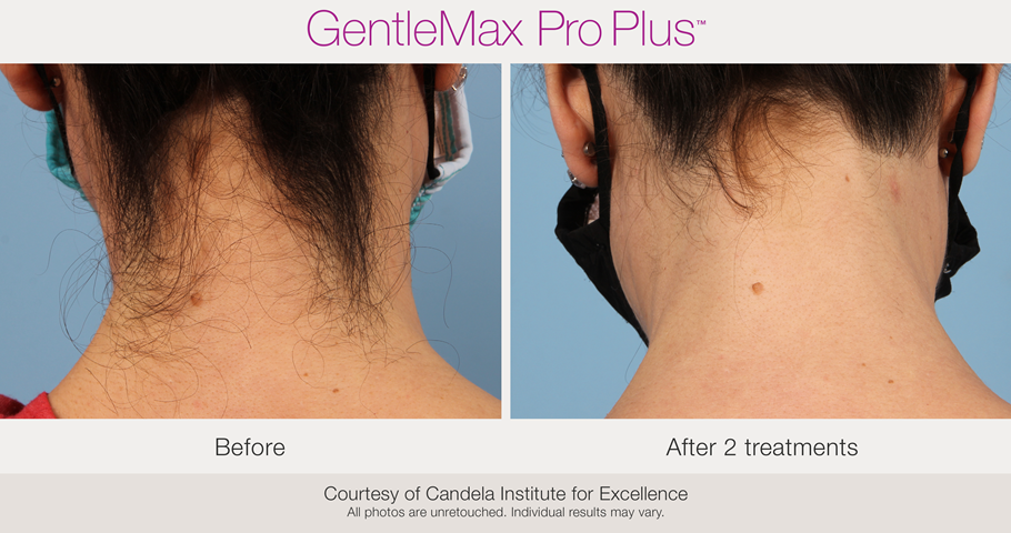 epilation gentle max pro plus glx nuque femme et homme