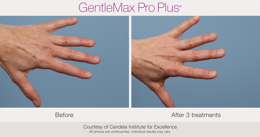 candela gentle max pro plus glx vasculaire mains