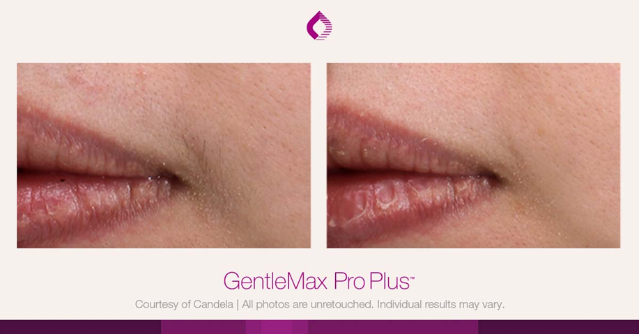 epilation gentle max pro plus glx levres femme et homme