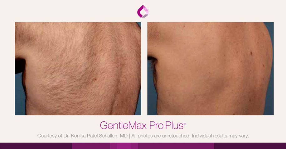 epilation gentle max pro plus glx dos homme résultâtes