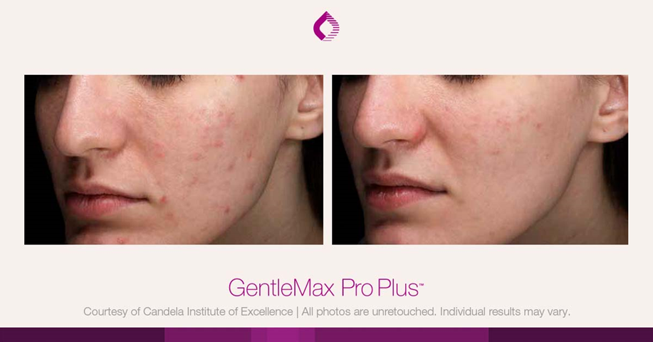 candela gentle max pro plus glx pigmentaire acnee visage