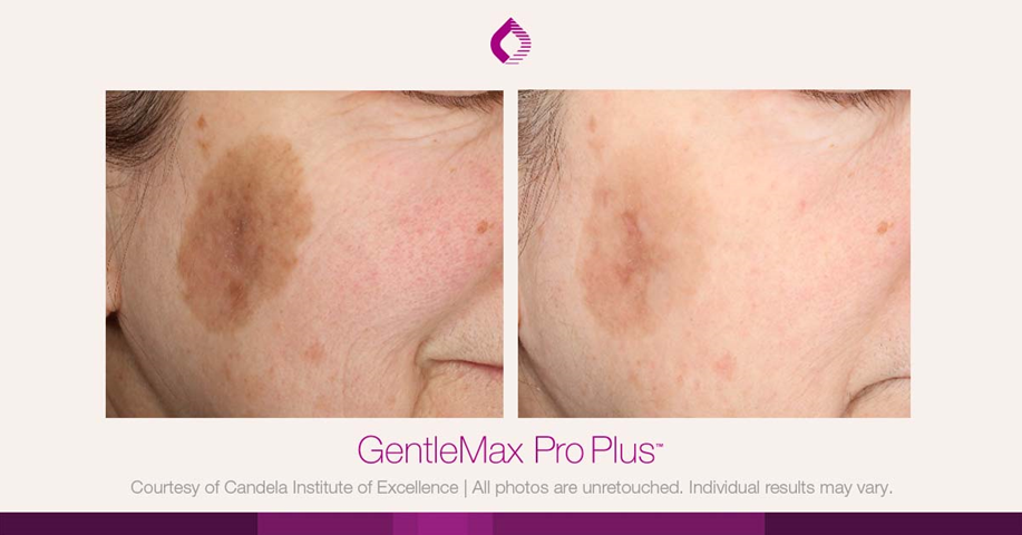 candela gentle max pro plus glx pigmentaire visage