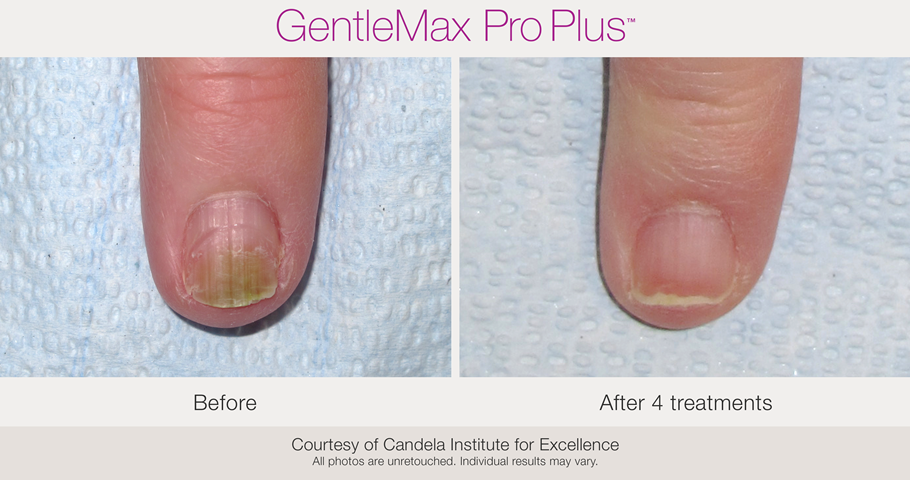 CANDELA GENTLE MAX PRO PLUS GLX TRAITEMENT ONYCHOMYCOSE